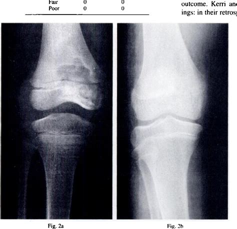 Figure 4 From Tuberculosis Of The Knee In Children Semantic Scholar
