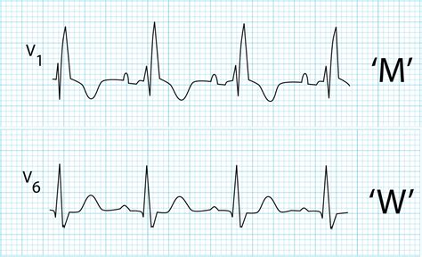 Incomplete Right Bundle Branch Block Symptoms And Causes