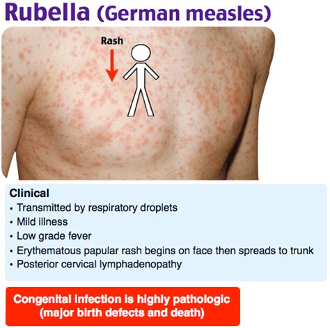 Rubella German Measles Rubella Also Called German Grepmed