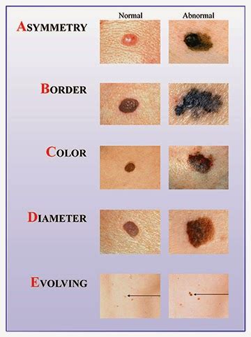 What does a normal mole look like. Melanoma - A Mole Gone Bad - The Eye Associates