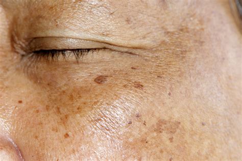 How Effective Is Laser Brown Spot Removal Prizant Dermatology