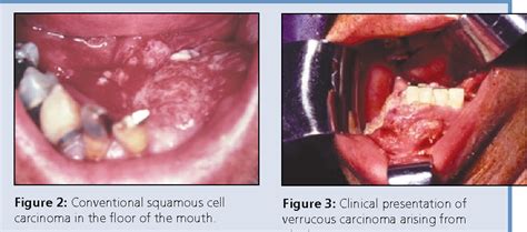 Figure 1 From Histologic Subtypes Of Oral Squamous Cell Carcinoma