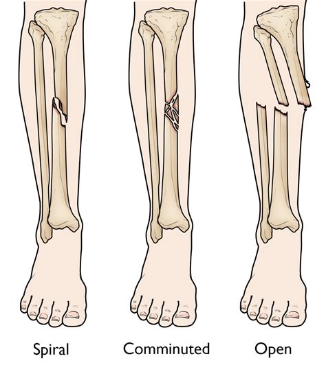 Tibia Shinbone Shaft Fractures Orthoinfo Aaos