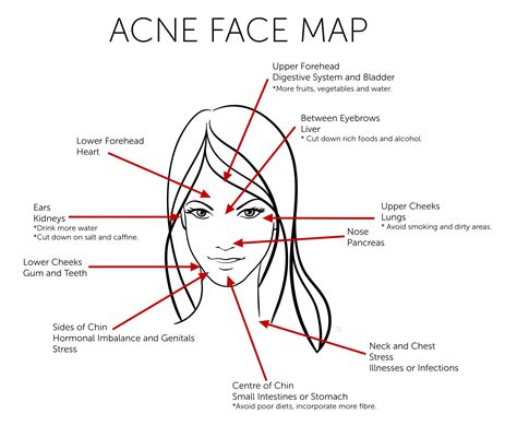 Anderes gegen pickel am rücken, pickel im gesicht, usw… sie wollen wissen was gegen pickel hilft bzw. FACE MAPPING: DAS WOLLEN EUCH EURE PICKEL SAGEN | Gesicht ...