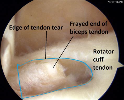 Mr Paul Jarrett Rotator Cuff Tears Murdoch Orthopaedic Clinic