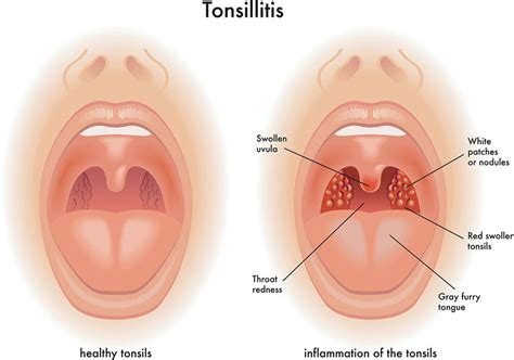 White Spots On Tonsils How To Get Rid Of White Spots On Tonsils