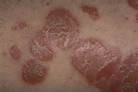 Psoriasis Skin Rash Pictures