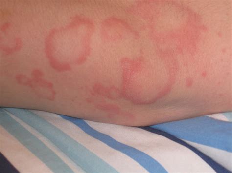 Other viruses can also cause mono. Cytomegalovirus