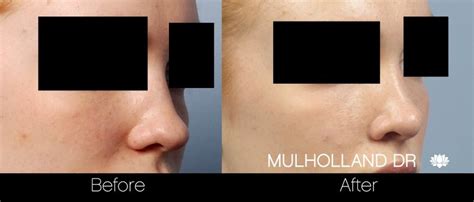 Rhinoplasty For Bulbous Nose Tip Causes And Treatment