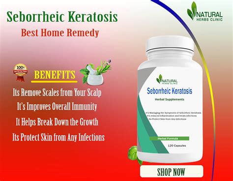 Natural Remedies For Seborrheic Keratosis Suitable Treatment Te By