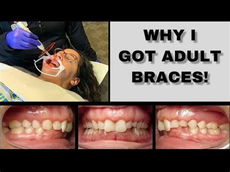 GETTING ADULT BRACES FULL PROCESS VLOG YouTube