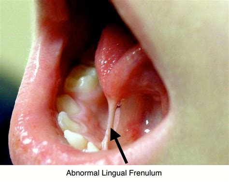 lingual frenum