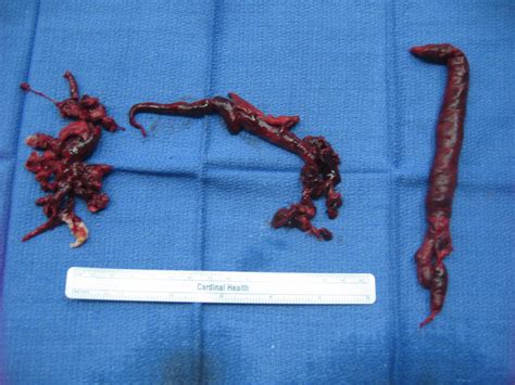Een kleine longembolie hoeft niet veel klachten te geven. Pulmonary Embolism - The Killer Clot in the Lungs • MyHeart