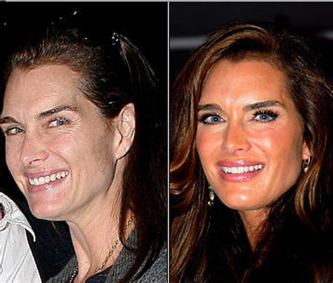 Brooke Shields Plastic Surgery Before And After Botox