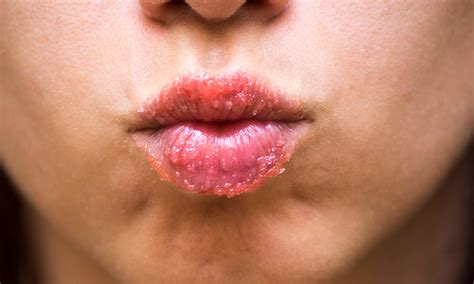 Dry Lip Treatments Ways To Treat Your Clients Chapped Lips Professional Skincare Guide