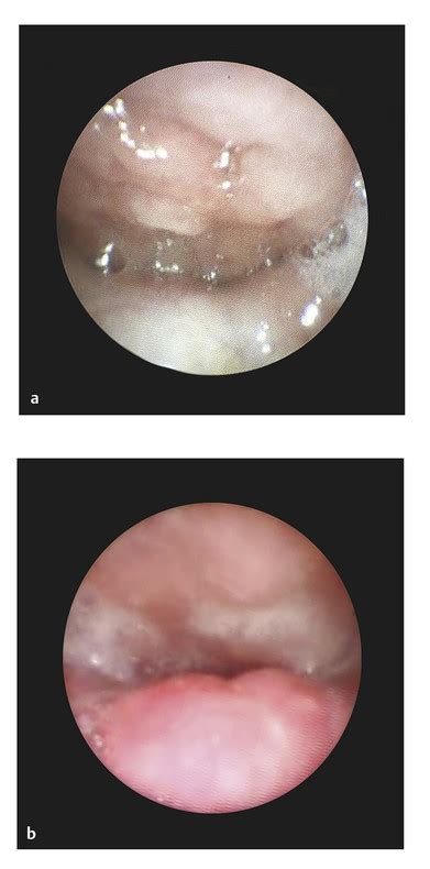 15 Cleft Palate | Plastic Surgery Key