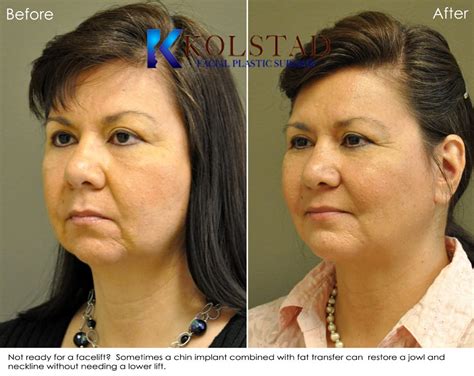 Asian Chin Enhancement San Diego Dr Kolstad Facial Plastics Only