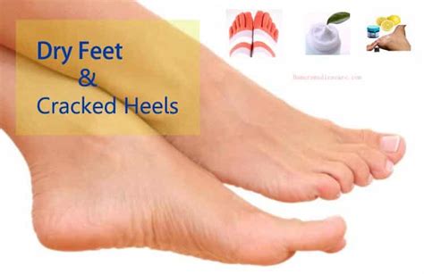 14 Helpful Home Remedies For Dry Feet And Cracked Heels
