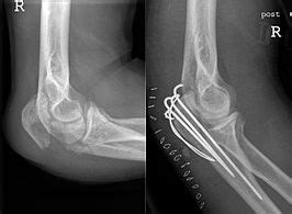 Olecranonfractuur - Wikipedia