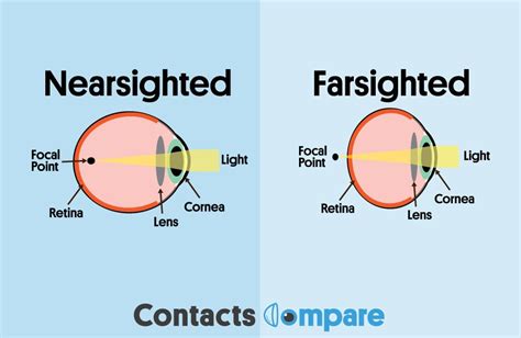 Nearsighted Vs Farsighted Contacts Compare