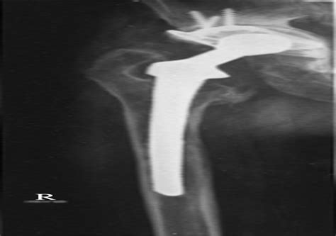 Infection Of A Total Hip Arthroplasty With Prevotella Loesch