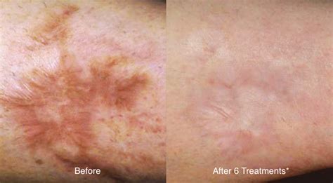 Tattoo laser removal in orange park on yp.com. forearm-scar-laser-treatment - Gentle Touch MediSpa