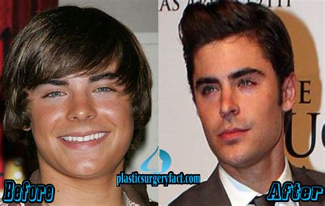More info about zac efron. Top 10 Celebrities with Nose Jobs Before and After - Plastic Surgery Facts