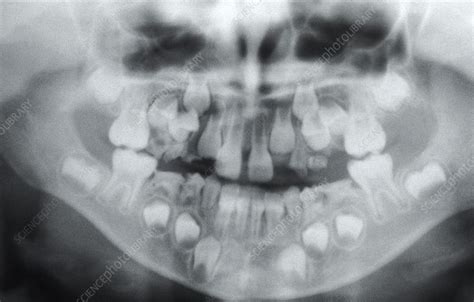 Dental X Ray 7 Year Old Child Stock Image C0235981 Science