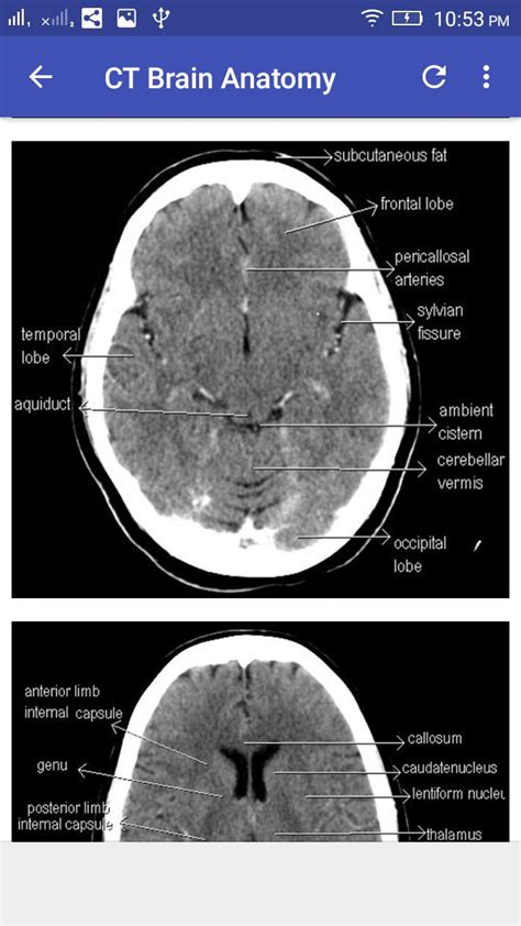 Get Anatomy Of Ct Scan Brain Background