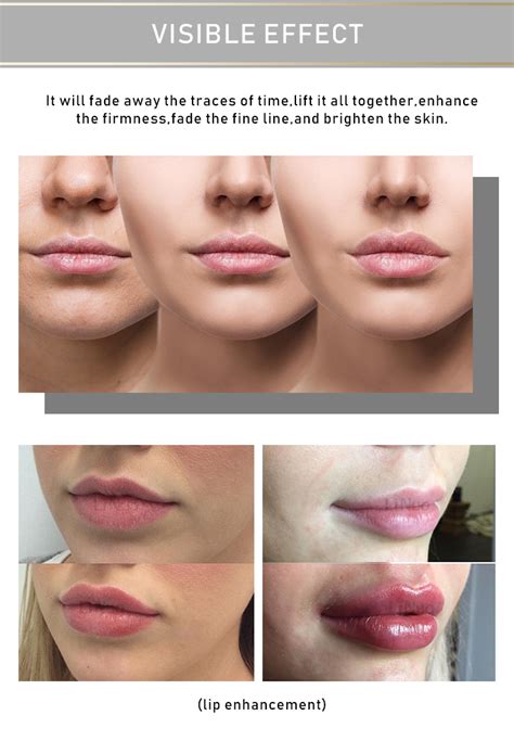 The marketing touts it as a device that can add volume to your lips without needles and with low risk of bruising and swelling. 2018 LINUO NEEDLE FREE Hyaluronic Pen Lip Dermal Filler ...