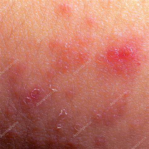 Экзема атопический дерматит симптом текстуры кожи стоковое фото