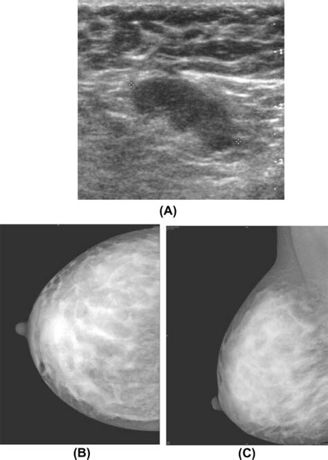 Us And Mammography Of Breast Carcinoma Lactating 30year Old Woman With
