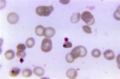 Free Picture Plasmodium Falciparum Malaria Parasite Blood Sample