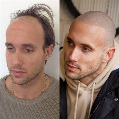 Shining A Light On Shiny Scalps Haircuts For Balding Men Balding