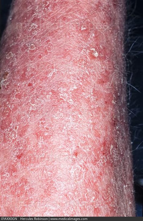 Stock Image Dermatology Psoriasis Very Red And Dry Scaly Patches With