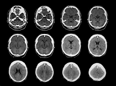 Normal Ct Scan Of Brain Anatomy Ct Scan Mri Vrogue Co