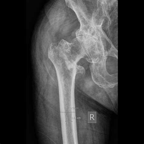 Trochanteric Fracture Pacs