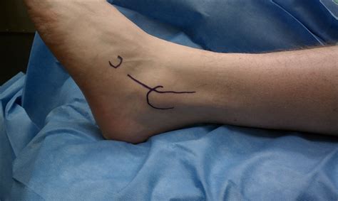 Anterior Approach To Ankle And Tarsus Approaches Orthobullets