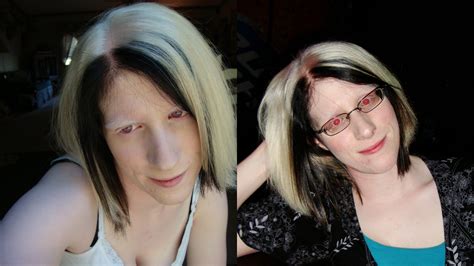 Albinism Platinum Hair And Dye Part One My Journey With Photos