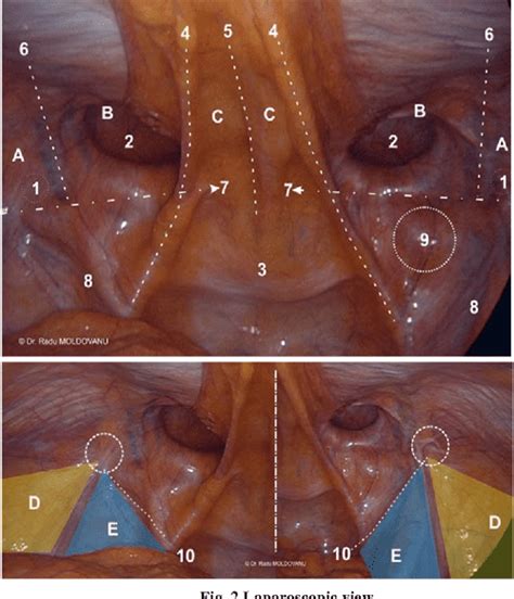 Laparoscopic Inguinal Hernia Repair Anatomy Anatomy S