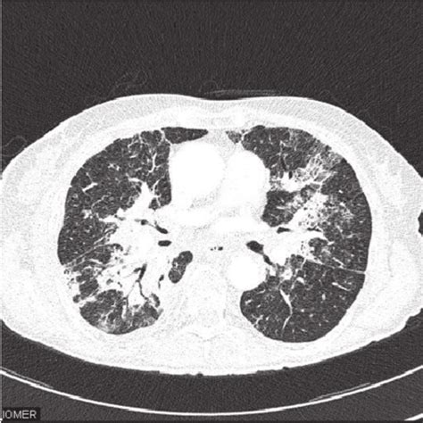 Chest Ct Scan April 2005 — Areas Of Consolidations With