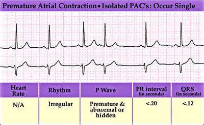 Pac Premature Atrial Contraction Ekg Interpretation Pr Interval Ekg