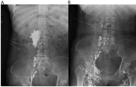 Figure 3 From Treatment Of Lymphatic Leakage After Retroperitoneal