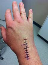 Pictures of After Hand Surgery Recovery