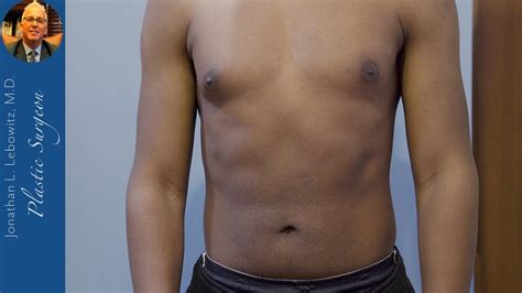 Fibro Fatty Pubertal Gynecomastia Puffy Nipple Surgery On 21 Yo By Dr