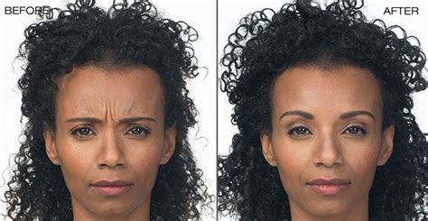 Compare botox prices, print discount coupons, find manufacturer promotions and details on available patient assistance programs. BOTOX Cosmetic Specialist | Heatlhy Image | Berkshire County