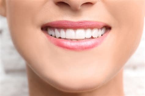 What Is The Procedure Of Teeth Bonding Before And After
