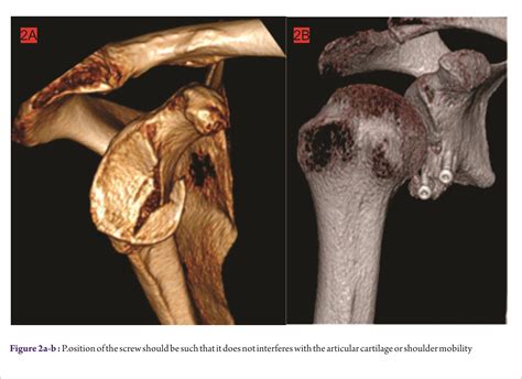 Arthroscopic Treatment Of Glenoid Fractures Acta Of Shoulder And