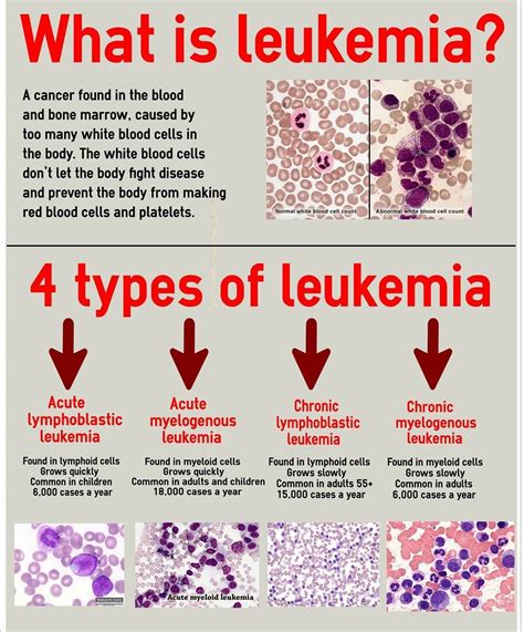 Types Of Leukemia Medical Laboratory Oncology Nursing