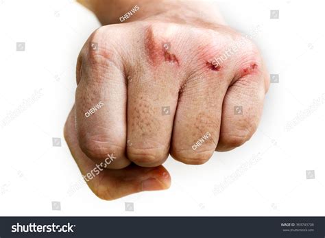 Hand Knuckles Anatomy